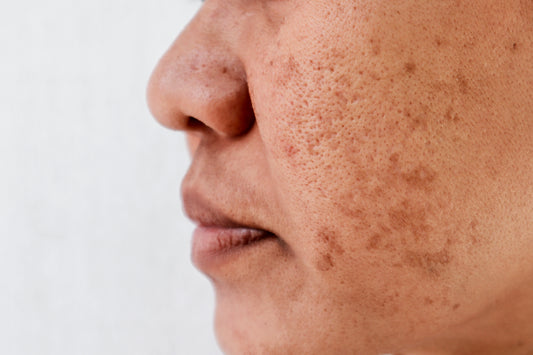 Hyperpigmentation: What Causes Dark Spots On Your Skin & How To Get Rid of Them