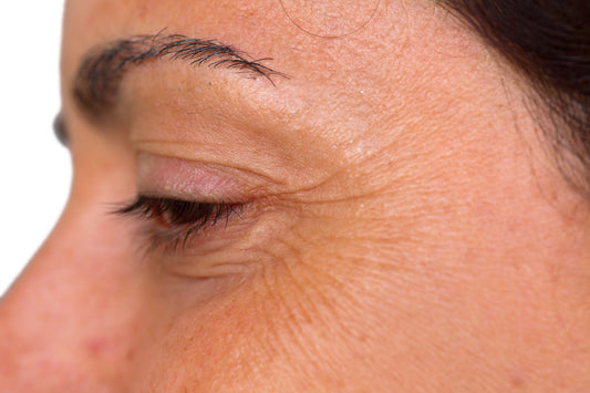 Crows Feet: How to Reduce, Treat & Prevent Wrinkles Around Your Eyes